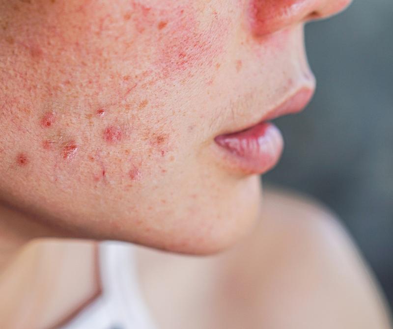 Rodzaje pryszczy i przyczyny