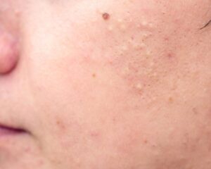 Jak skutecznie walczyć z trądzikiem podskórnym? Praktyczne porady i sprawdzone metody