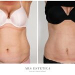 Odkryj nowoczesne piękno: Vaser lipo w liposukcji 3D