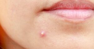 Poznaj różnorodność rodzajów pryszczy i jak z nimi walczyć