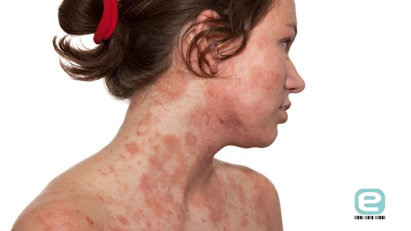 Choroby skóry a zdrowie psychiczne