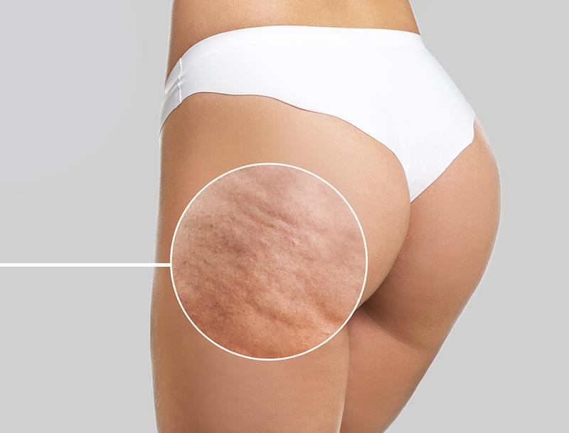 Ćwiczenia na cellulit łydek