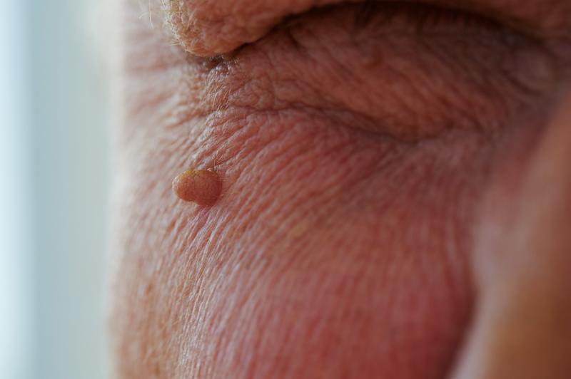 Dieta i styl życia a brodawki