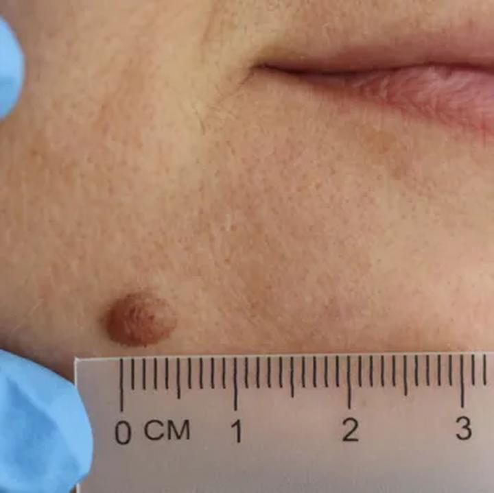 Domowe sposoby na brodawki