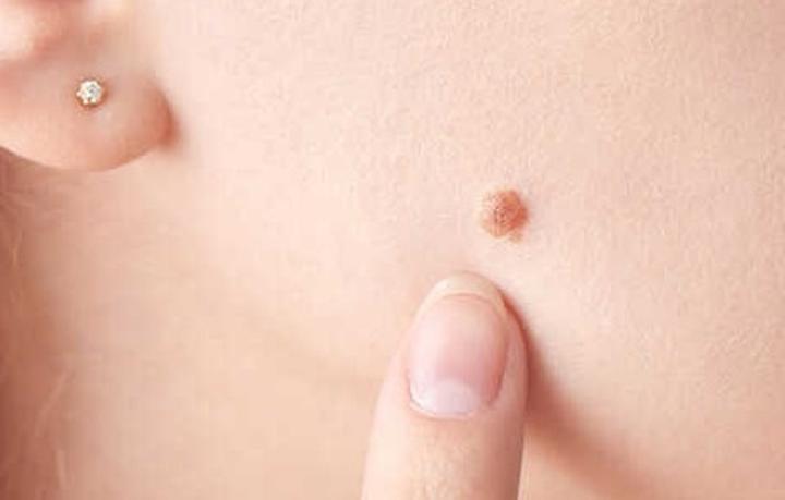 Kiedy do dermatologa