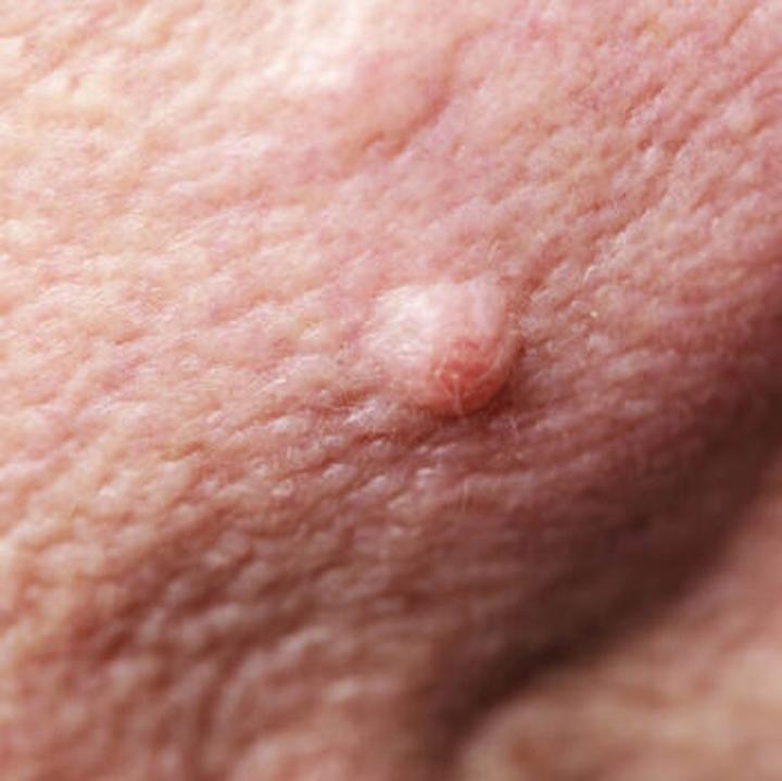 Pielęgnacja skóry po usunięciu brodawek