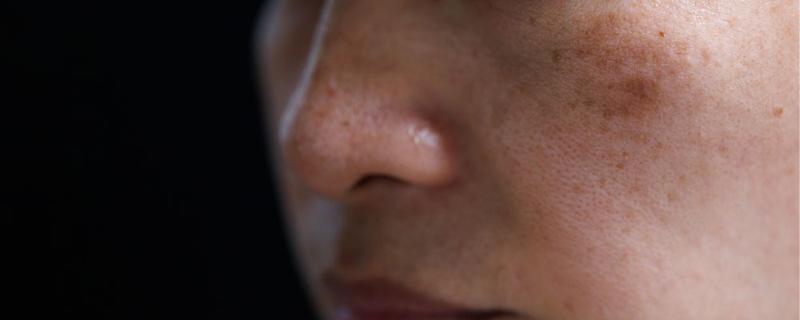 Przyczyny przebarwień skóry