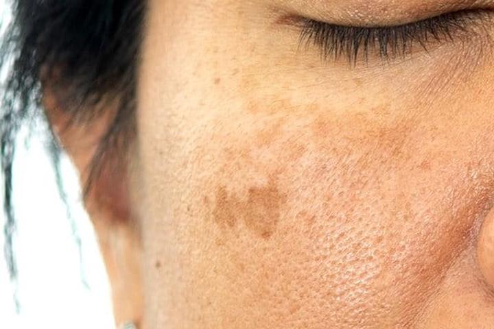 Skuteczne metody leczenia przebarwień