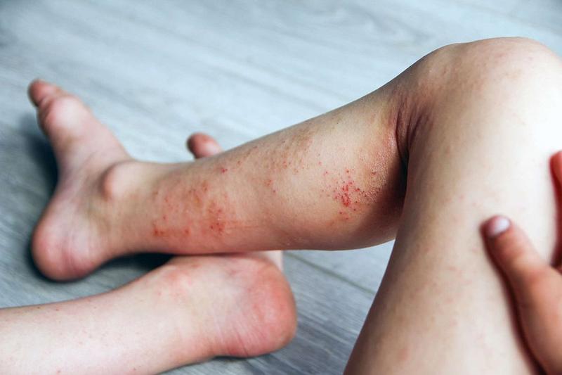 Zarządzanie stresem w chorobach skóry