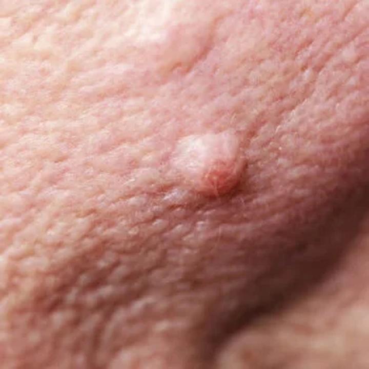 Jak skutecznie radzić sobie z brodawkami na twarzy? Sprawdź nasze porady!