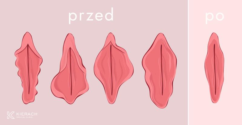 Chirurgia intymna kobiet