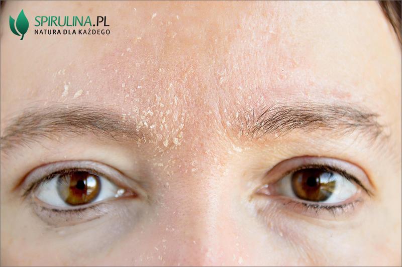 Codzienna pielęgnacja skóry przy łojotokowym zapaleniu