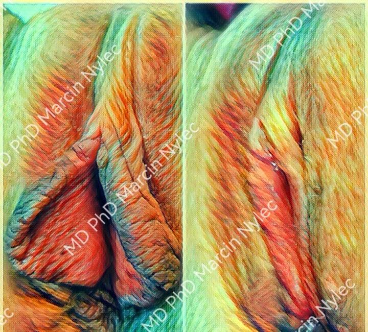 Czym jest labioplastyka