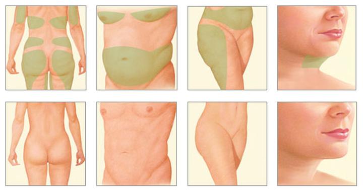 Odsysanie tłuszczu metody i efekty