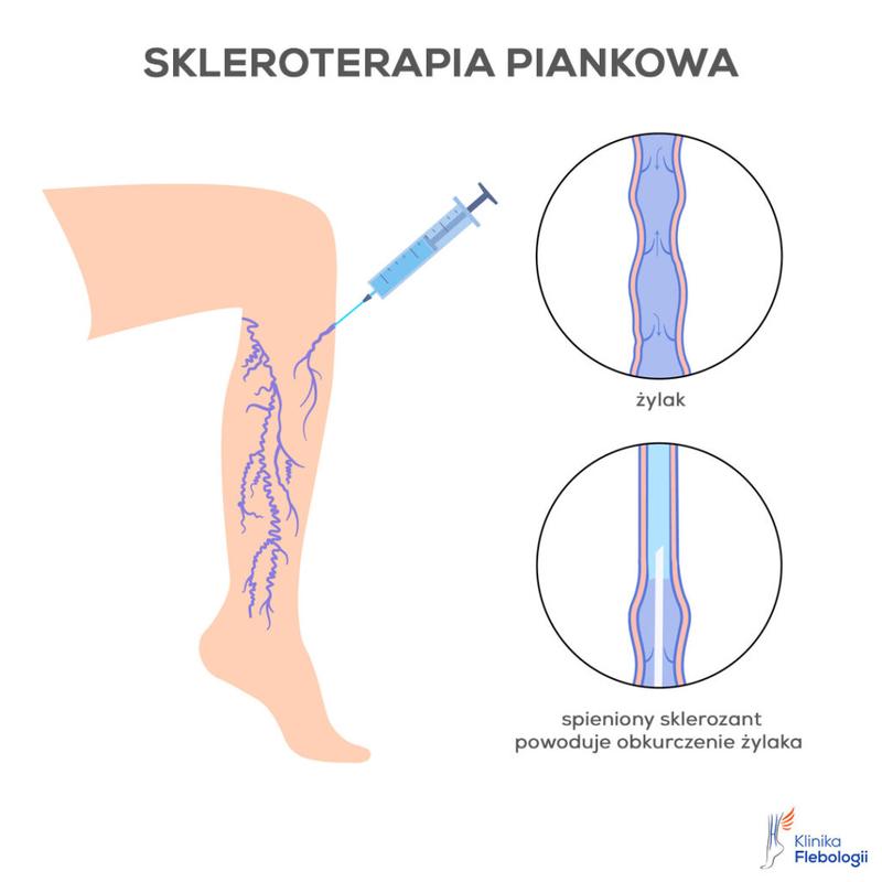 Porównanie metod leczenia żylaków