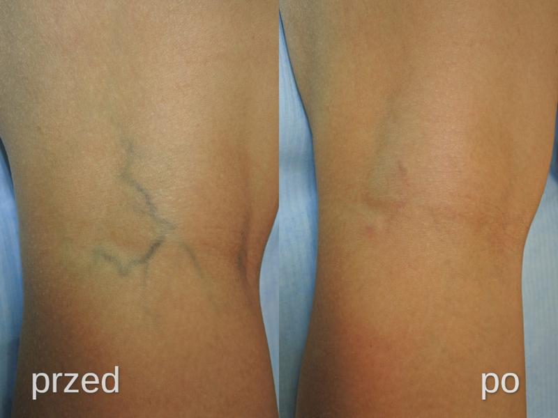 Przebieg skleroterapii i efekty