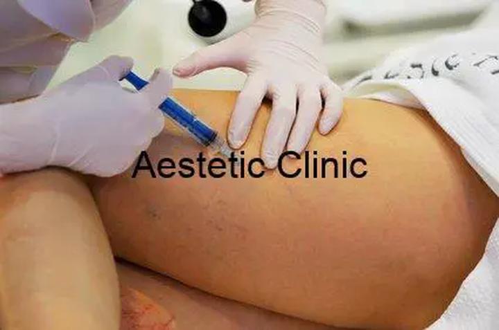 Skleroterapia żylaków