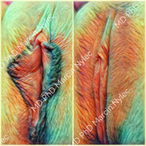 Labioplastyka – jak poradzić sobie z przerosłymi wargami sromowymi?