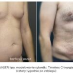Odsysanie tłuszczu – klucz do wymarzonej sylwetki i pewności siebie
