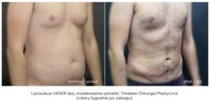 Odsysanie tłuszczu – klucz do wymarzonej sylwetki i pewności siebie