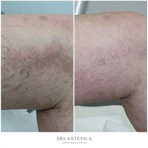 Skleroterapia żylaków – skuteczna metoda na pozbycie się problemów z żyłami