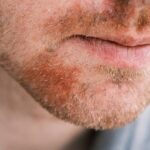 Skuteczne metody na złagodzenie łojotokowego zapalenia skóry