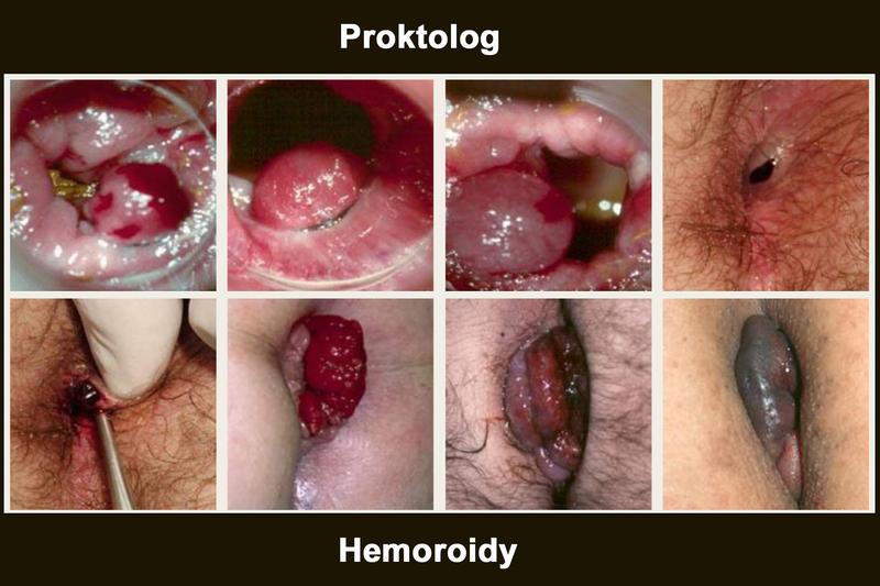 Ćwiczenia fizyczne na hemoroidy