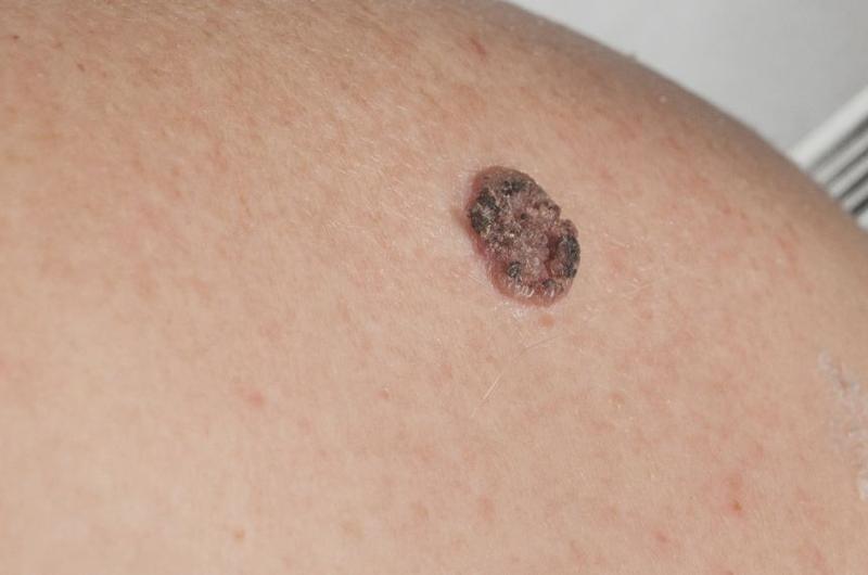 Nowoczesne techniki usuwania znamion