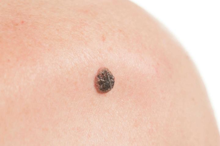 Zalety i wady usuwania znamion