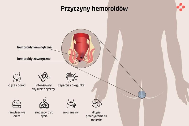 Jak skutecznie radzić sobie z hemoroidami – poradnik dla każdego