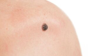Skuteczne metody usuwania znamion – kiedy warto podjąć decyzję?