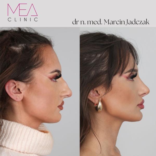 Koszt operacji plastycznej