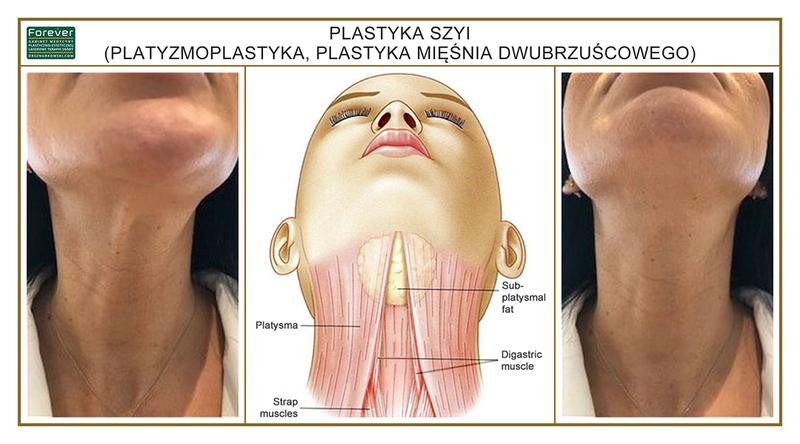 Lifting szyi a liposukcja
