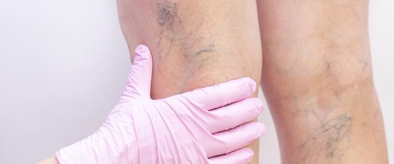 Pajączki naczyniowe