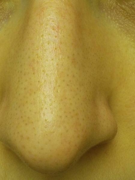 Przyczyny trądziku zaskórnikowego