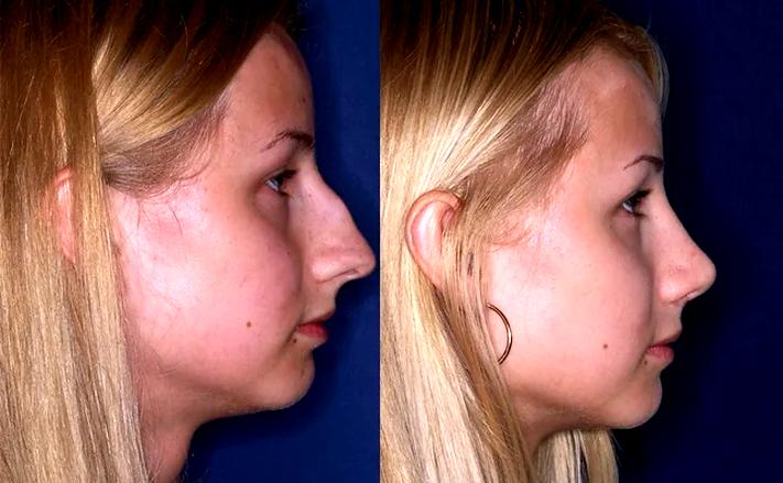 Techniki operacyjne nosa