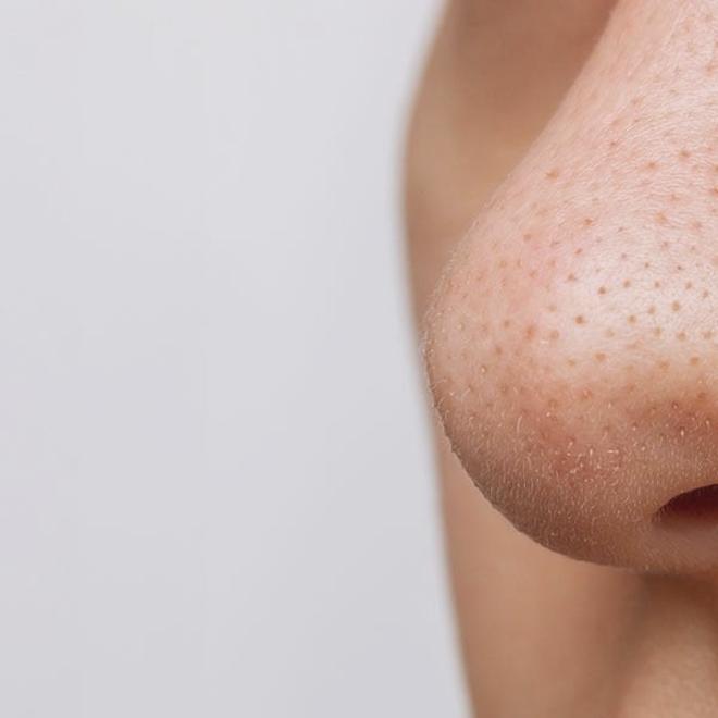 Trądzik zaskórnikowy