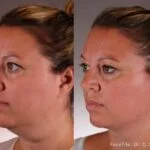 Jak lifting szyi może odmienić Twoje spojrzenie na urodę?