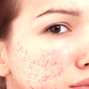 Jak skutecznie radzić sobie z tradzikiem zaskórnikowym na skórze?