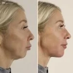 Nowe podejścia w modelowaniu zuchwy dla pięknego uśmiechu