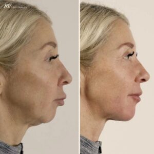 Nowe podejścia w modelowaniu zuchwy dla pięknego uśmiechu