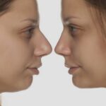 Plastyka nosa – wszystko, co powinieneś wiedzieć przed podjęciem decyzji