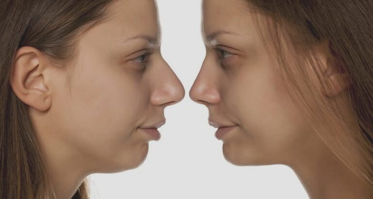 Plastyka nosa – wszystko, co powinieneś wiedzieć przed podjęciem decyzji