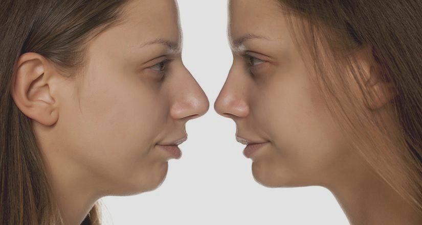 Plastyka nosa – wszystko, co powinieneś wiedzieć przed podjęciem decyzji