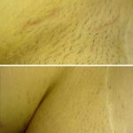 Jak długo można cieszyć się gładką skórą po depilacji laserowej?